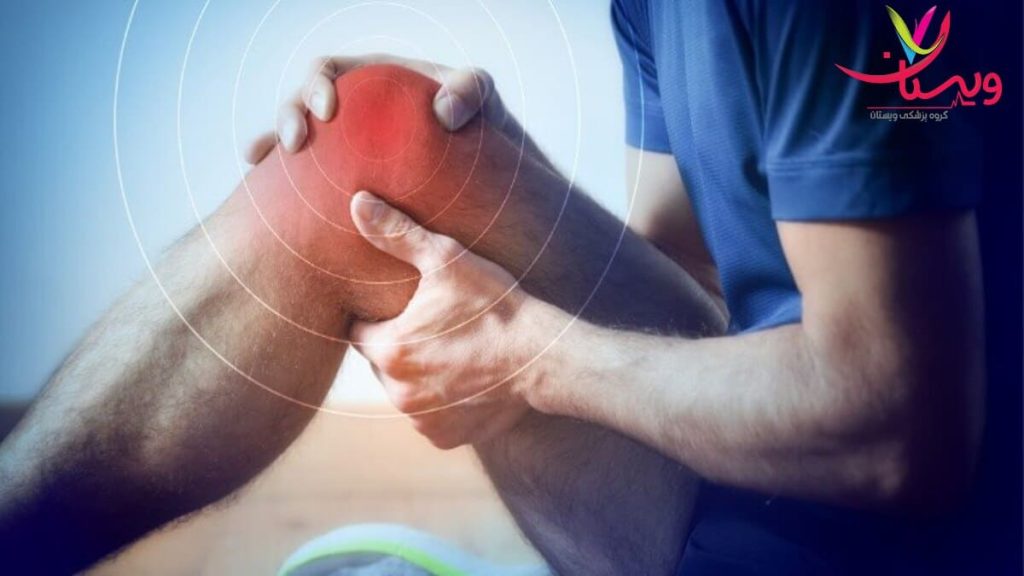 علائم شایع آرتروز زانو شامل درد و تورم درد و التهاب مفصل زانو در اثر آرتروز
