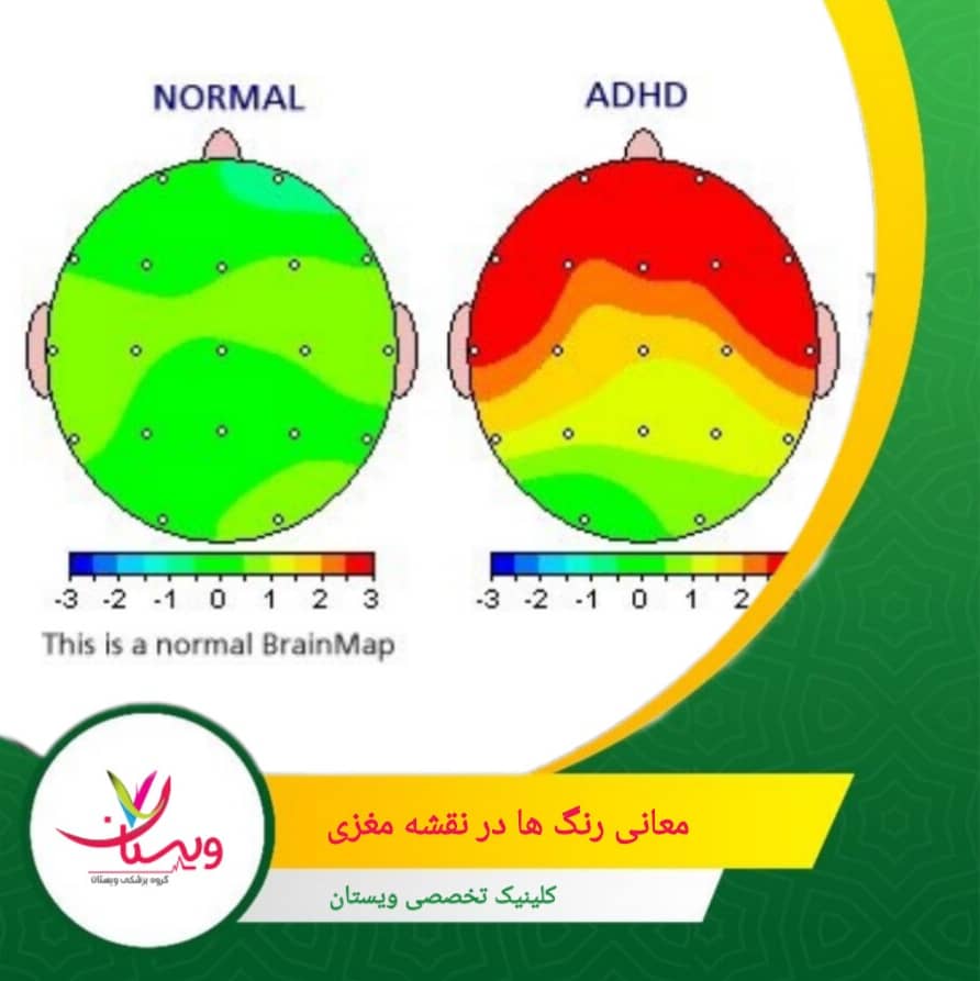 وقتی یک ناحیه آبی باشد، یعنی آن بخش از مغز کندتر یا ضعیفتر از حالت معمول کار میکند. معانی رنگها در نقشه مغزی