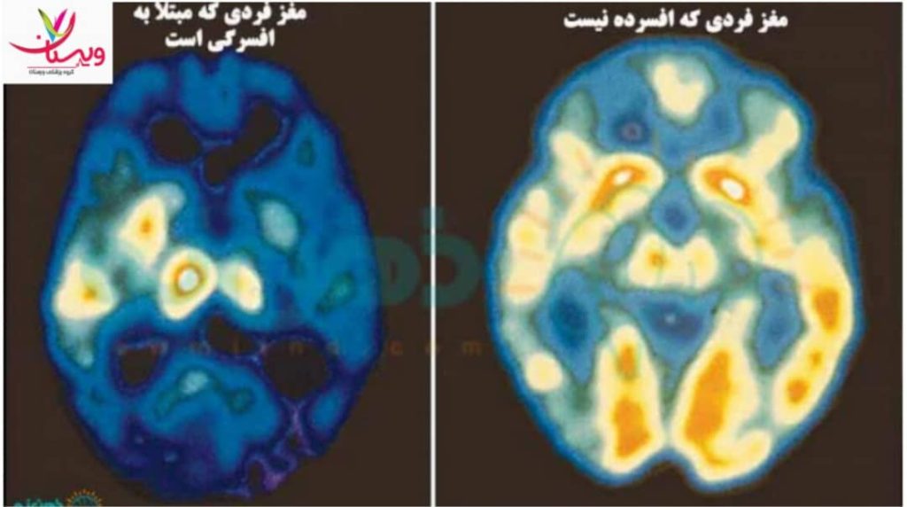 الگوهای غیرطبیعی مغزی با شدت افسردگی همبستگی دارند و میتوانند به پیشبینی شدت علائم کمک کنند. تفاوت نقشه مغزی فرد افسرده با فرد سالم