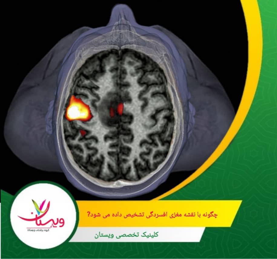 این روش بهویژه در ترکیب با تکنیکهای هوش مصنوعی مانند یادگیری ماشین میتواند دقت تشخیص را افزایش دهد. چگونه با نقشه مغزی افسردگی تشخیص داده میشود؟