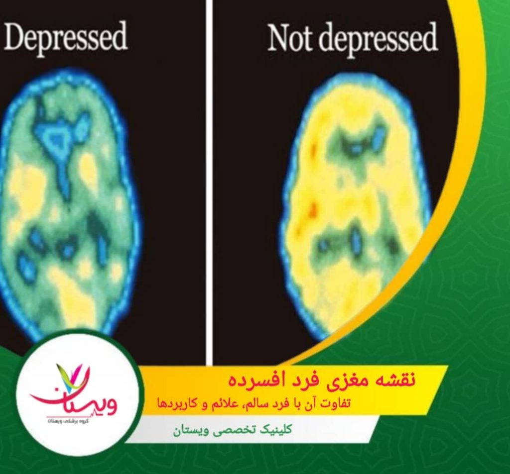 نقشه مغزی فرد افسرده| تفاوت آن با فرد سالم، علائم وکاربرد ها