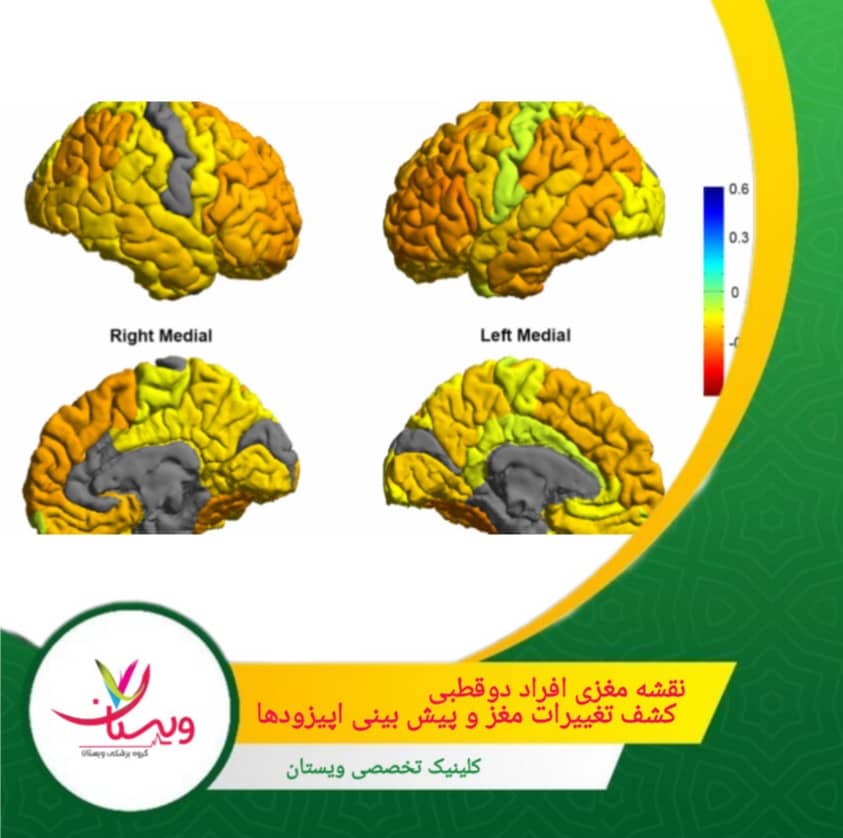 نقشه مغزی افراد دو قطبی: کشف تغییرات مغز و پیشبینی اپیزودها