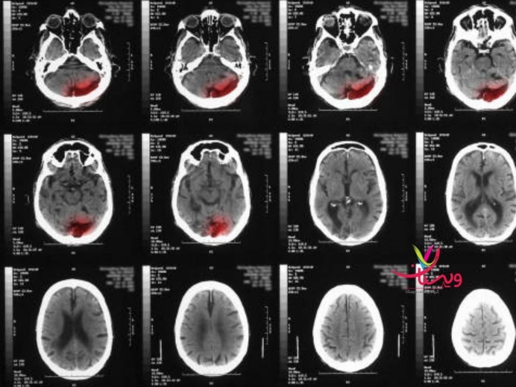 اسکیزوفرنی اسکن مغز اسکیزوفرنی