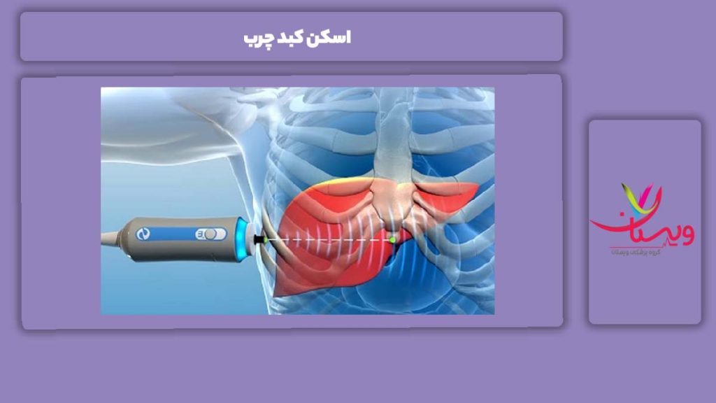 مزایای انجام اسکن کبد چرب اسکن کبد چرب