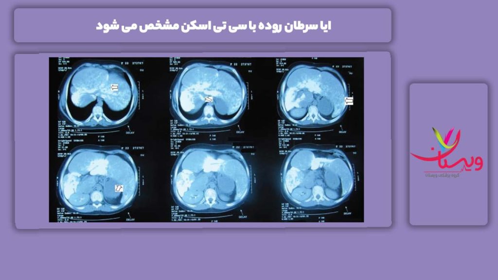 ویژگی سی تی اسکن برای تشخیص سرطان روده ایا سرطان روده با سی تی اسکن مشخص می شود