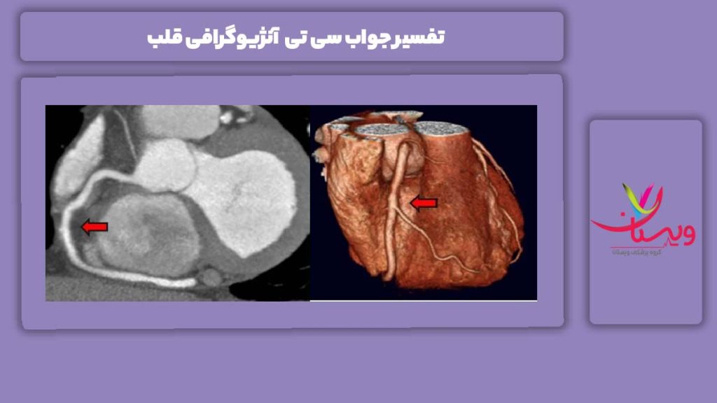 شرح جواب سی تی آنژیو تفسیر جواب سی تی آنژیوگرافی قلب