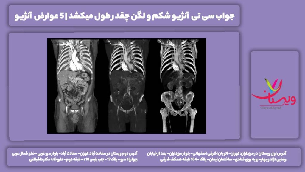 سی تی آنژیو شکم و لگن