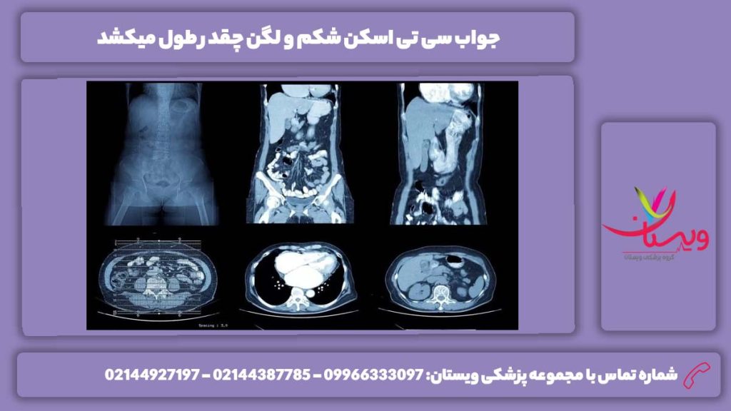 جواب سی تی آنژیو شکم و لگن چقدر طول میکشد سی تی آنژیو شکم و لگن