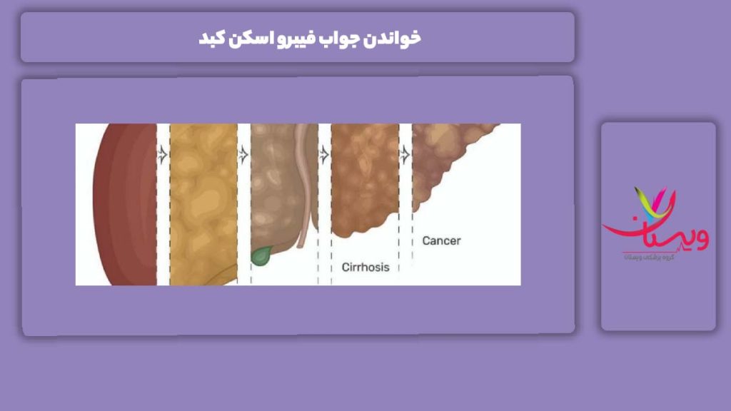خواندن جواب فیبرو اسکن کبد خواندن جواب فیبرو اسکن کبد