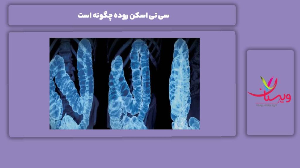 مرحلههای سی تی اسکن روده سی تی اسکن روده چگونه است
