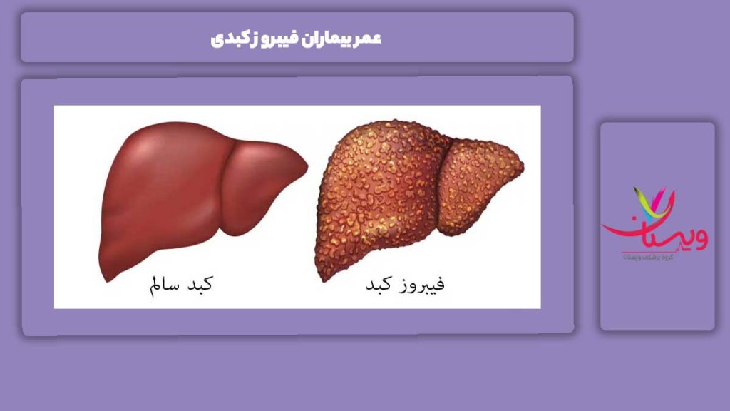 مراحل فیبروز و تاثیر آن بر عمر عمر بیماران فیبروز کبدی