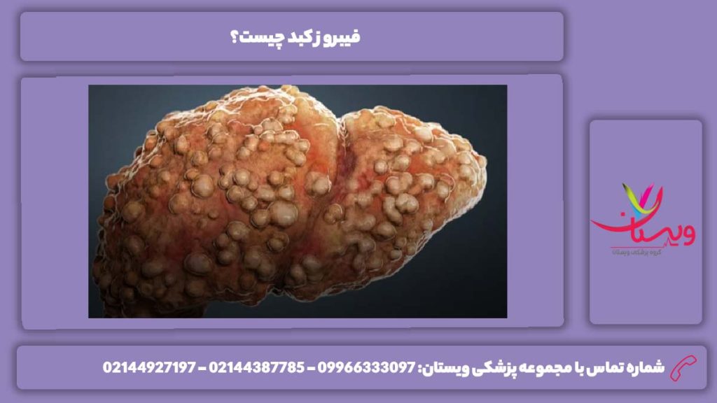 تعریف فیبروز کبد فیبروز کبد چیست؟