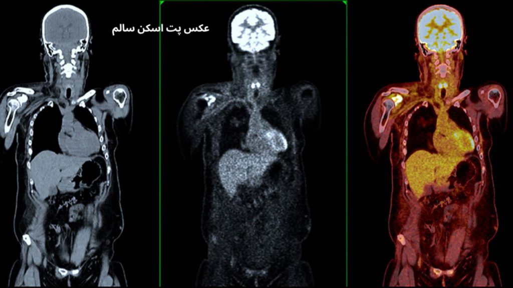 نقاط قرمز در اسکن نقاط قرمز در اسکن استخوان نشانه چیست؟