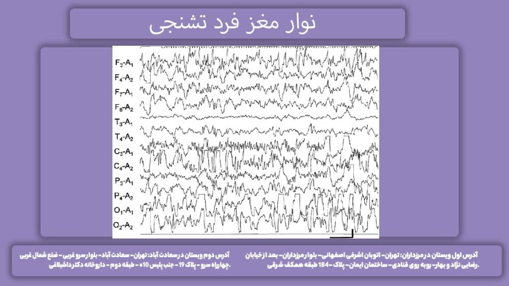 نوار مغز فرد تشنجی نوار مغز افراد دچار تشنج