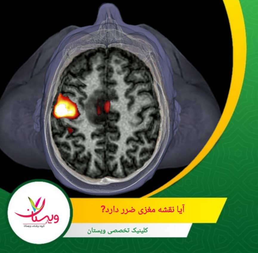 تنها در موارد بسیار نادر ممکن است پوست سر در محل تماس الکترودها کمی قرمز یا تحریک شود که موقتی است و به سرعت برطرف میشود. آیا نقشه مغزی ضرر دارد؟