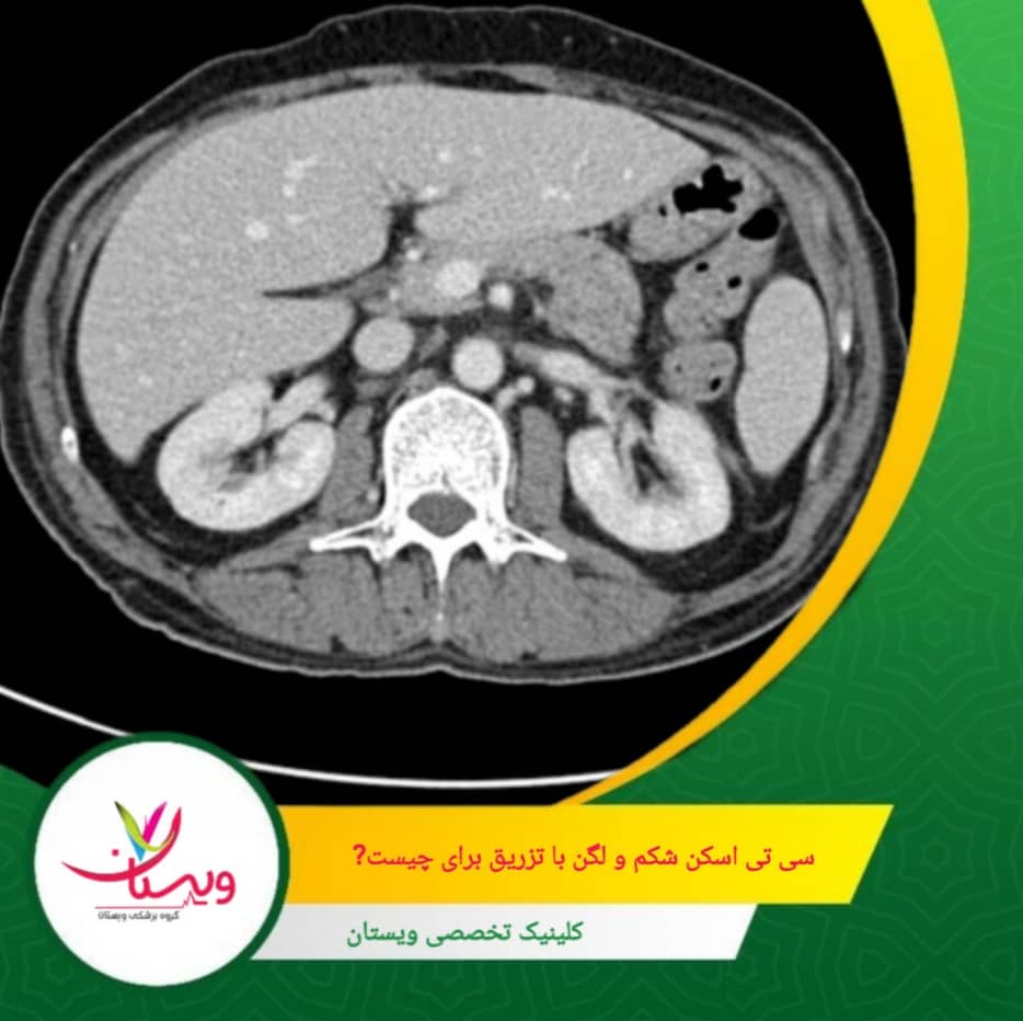 تزریق ماده حاجب باعث تقویت کنتراست تصاویر میشود و به پزشک امکان میدهد جزئیات دقیقتری از ساختارهای داخلی بدن مشاهده کند. این ویژگی به ویژه در بررسی عروق خونی و شریانها اهمیت دارد. سی تی اسکن شکم و لگن با تزریق برای چیست؟