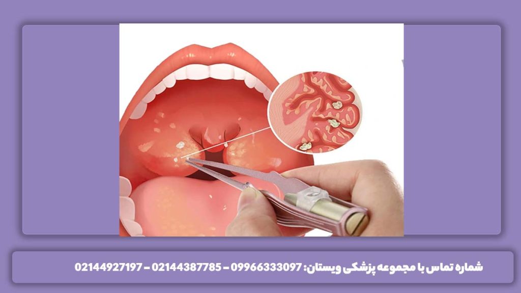 مشاهده زائدههای گلو انواع مختلف آندوسکوپی حلق و گلو