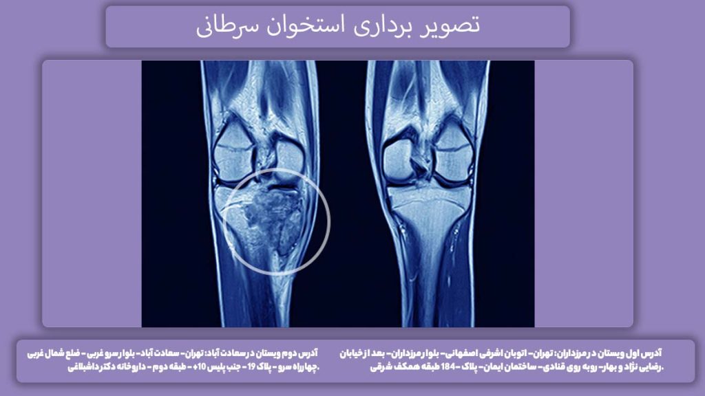اسکن کردن استخوان سرطانی تصویر برداری استخوان سرطانی