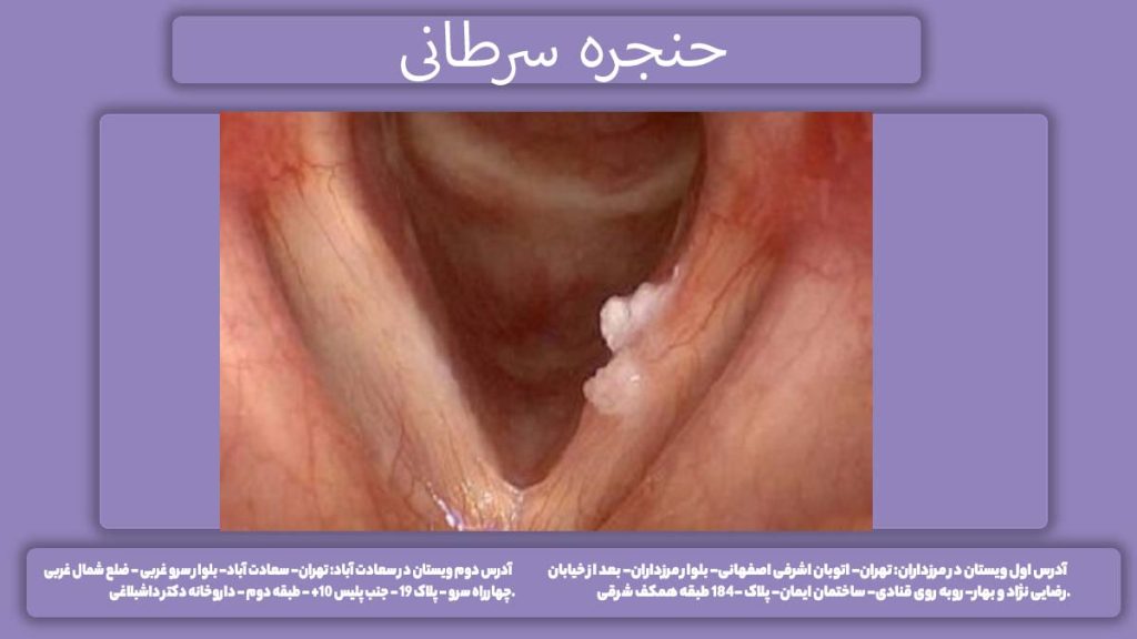 سرطانی شدن حنجره حنجره سرطانی