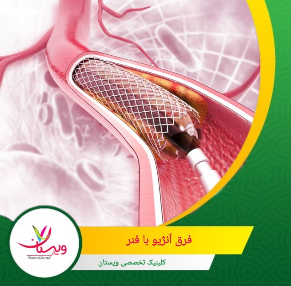 آنژیوگرافی یک روش تشخیصی و تصویربرداری است که با تزریق ماده حاجب، وضعیت رگهای خونی را نشان میدهد و به پزشک کمک میکند محل تنگی یا انسداد رگها را شناسایی کند. فرق آنژیو با فنر