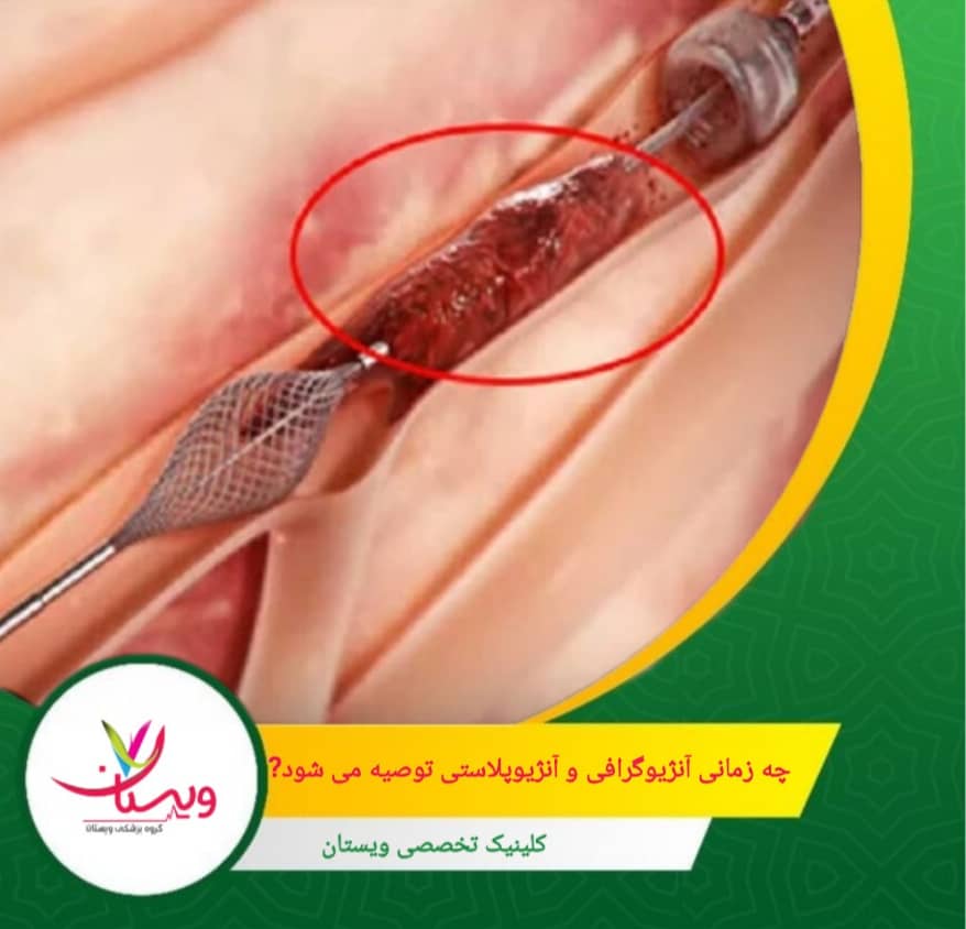 چه زمانی آنژیوگرافی یا آنژیوپلاستی توصیه میشود؟