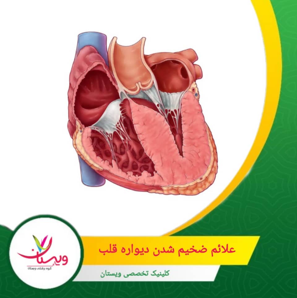 تجمع مایعات در بدن، مخصوصاً در اندامهای تحتانی، میتواند نشانهای از نارسایی قلبی ناشی از ضخیم شدن دیواره باشد. علائم ضخیم شدن دیواره قلب