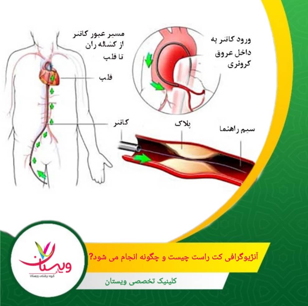 فشارها و جریان خون در بخشهای مختلف قلب اندازهگیری میشود و در صورت نیاز، نمونه خون یا ماده حاجب برای تصویربرداری دقیقتر استفاده میگردد. آنژیوگرافی کت راست چیست و چگونه انجام میشود؟