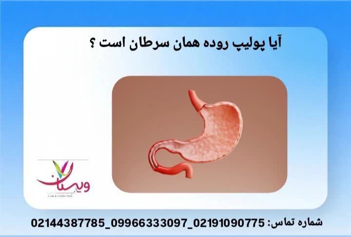 تفاوت پولیپ و سرطان روده از کجا بفهمیم پولیپ روده داریم