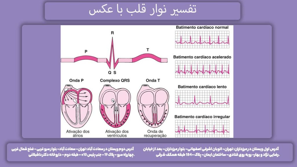 گزارش نوار قلب با عکس تفسیر نوار قلب با عکس
