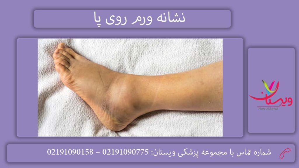 علت بروز ورم پاها