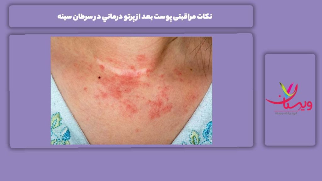 کارهایی که برای مواظبت از پوست نباید انجام داد پرتو درماني در سرطان سينه
