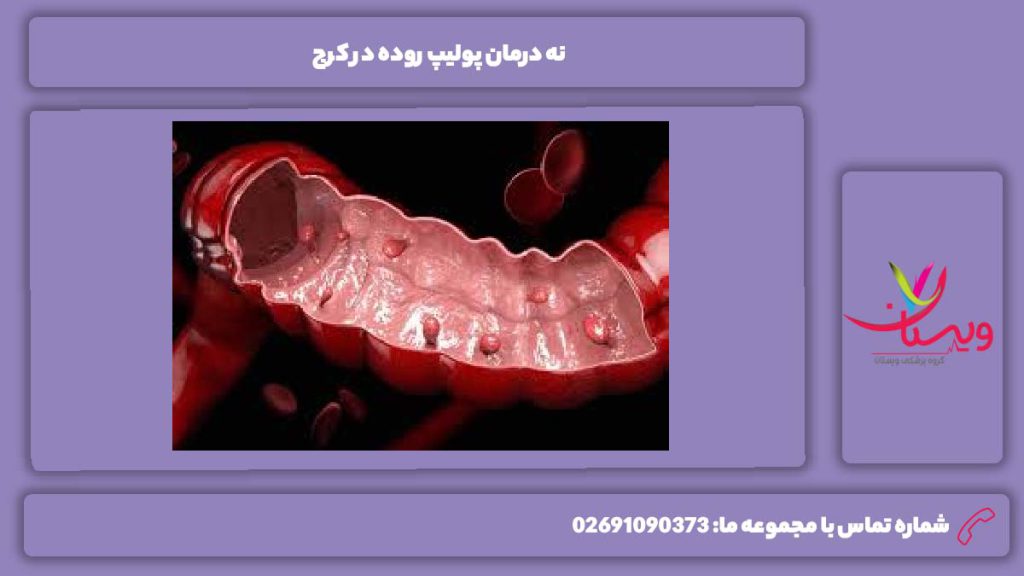 روشهای درمانی درمان پولیپ روده در کرج