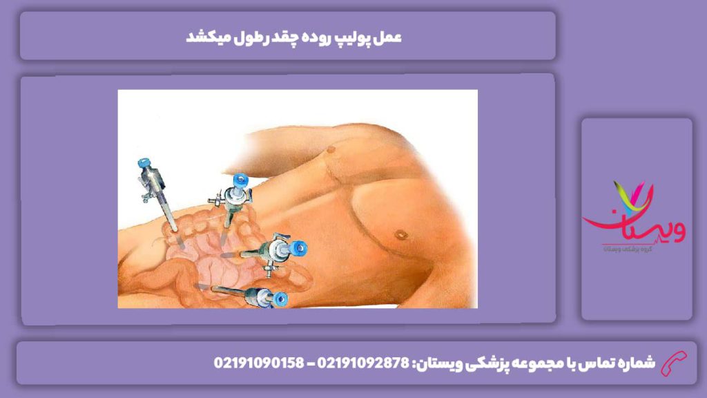 دلایل مؤثر بر مدت زمان عمل پولیپ روده چقدر طول میکشد