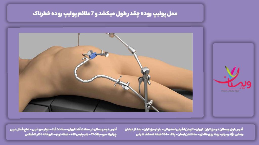 عمل پولیپ روده چقدر طول میکشد