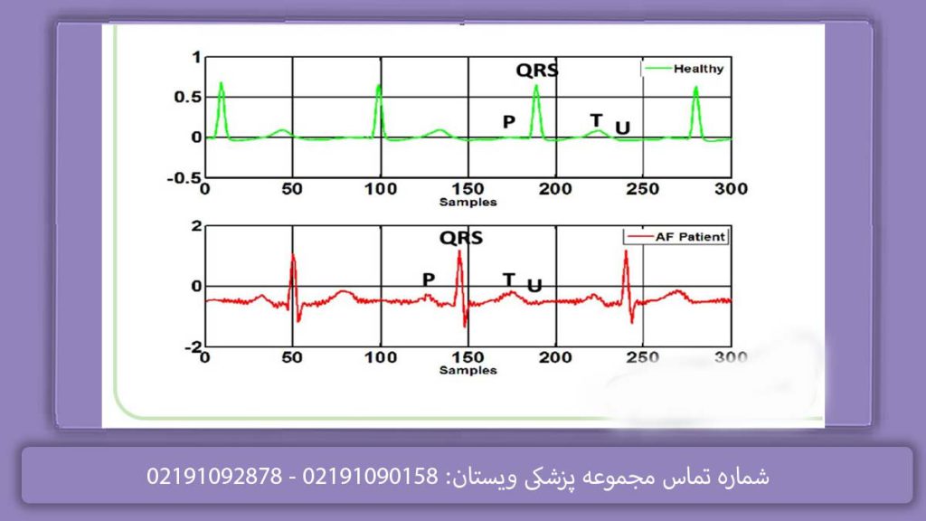 ECG مشکلدار و مریض نوار قلب مریض