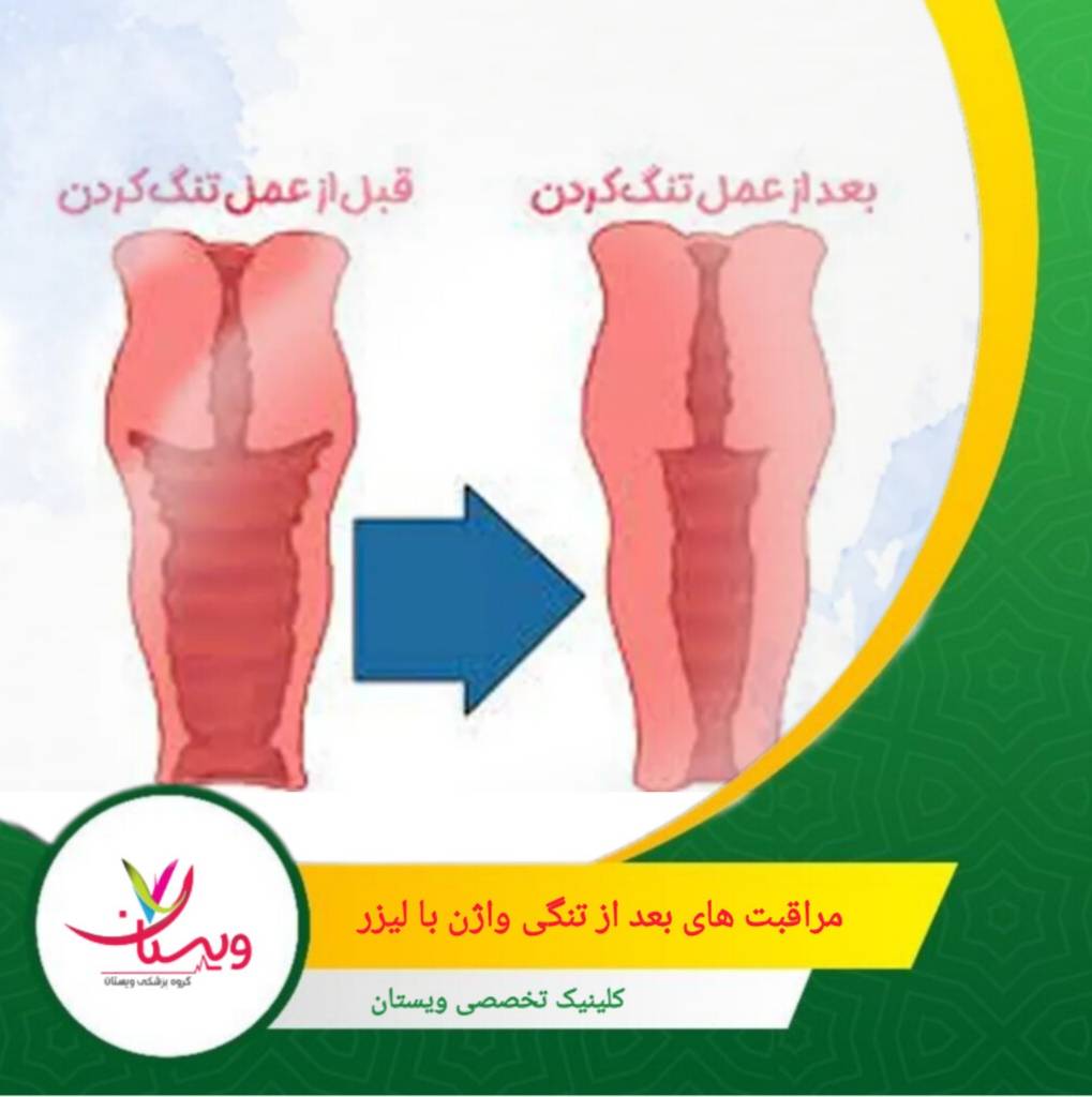 مراقبتهای بعد از لیزر نقش مهمی در ماندگاری نتایج دارند و مستقیماً روی «ارزش» هزینه پرداختشده اثر میگذارند. مراقبتهای بعد از تنگی واژن با لیزر