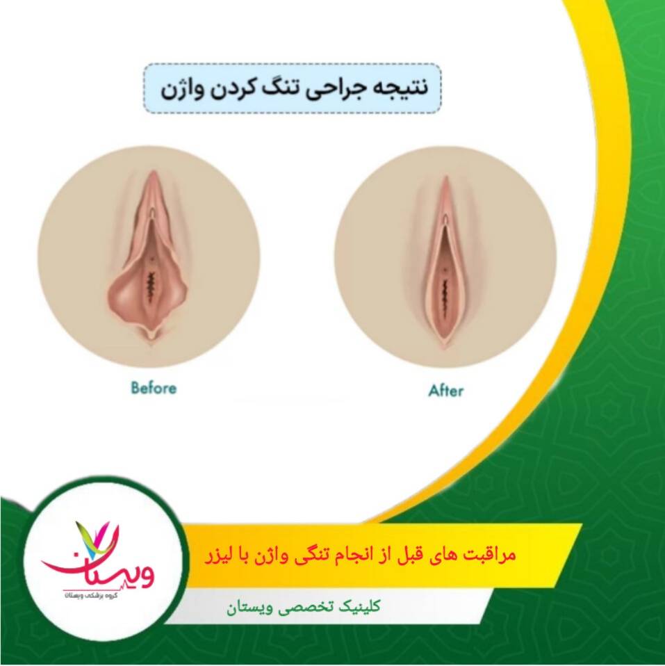 رعایت مراقبتهای قبل از لیزر، هم روی نتیجه نهایی اثر دارد و هم از هزینههای اضافی جلوگیری میکند. مراقبتهای قبل از انجام تنگی واژن با لیزر