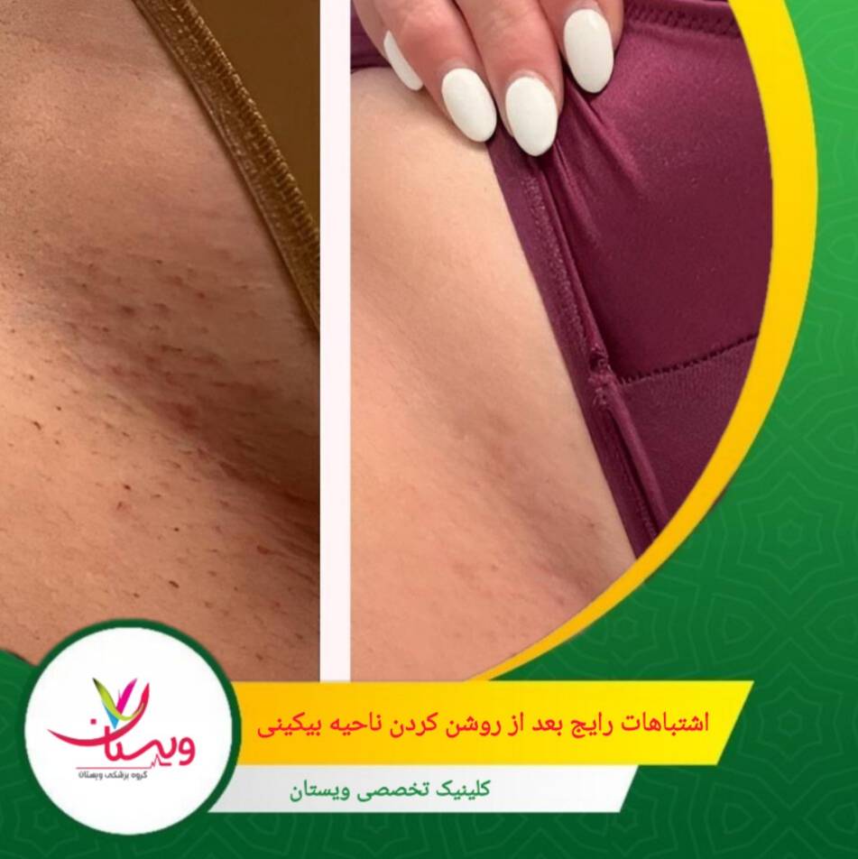 قطع درمان قبل از تکمیل جلسات باعث می شود نتیجه درمان ناقص بماند و یا خیلی زود از بین برود. اشتباهات رایج بعد از روشن کردن ناحیه بیکینی