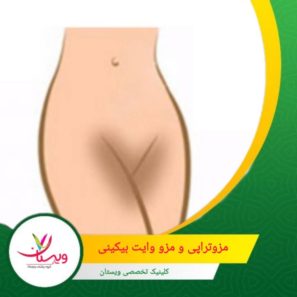 در بسیاری از موارد، ترکیب مزوتراپی با لیزر یا پیلینگ بهترین نتیجه را میدهد. مزوتراپی و مزو وایت بیکینی
