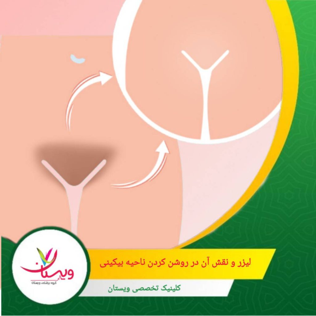 لیزر بهتنهایی برای تیرگیهای شدید کافی نیست، اما پایهای بسیار مهم برای هر برنامه روشنکننده حرفهای محسوب میشود. لیزر و نقش آن در روشن کردن ناحیه بیکینی