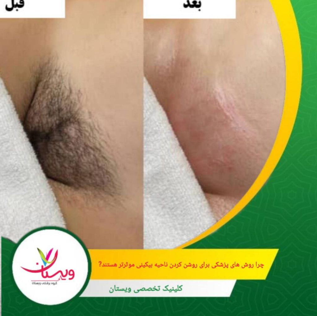 چرا روشهای پزشکی برای روشن کردن ناحیه بیکینی مؤثرتر هستند؟