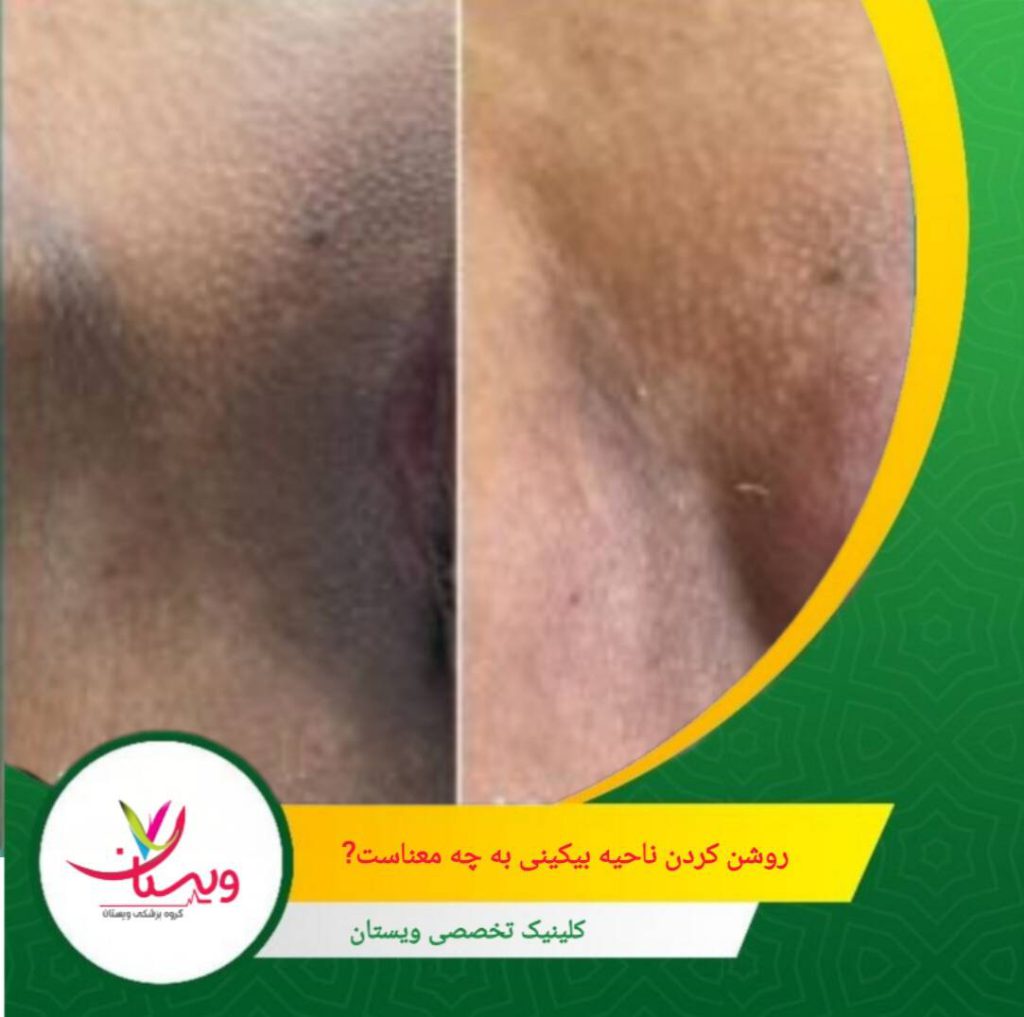 روشن کردن ناحیه بیکینی به مجموعهای از روشها گفته میشود که هدف آنها کاهش تیرگی، یکنواختسازی رنگ پوست و بازگرداندن شفافیت طبیعی این ناحیه حساس است. روشن کردن ناحیه بیکینی دقیقاً به چه معناست؟