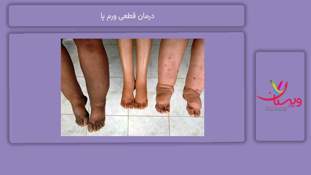روشهای غیر دارویی برای کاهش ورم درمان قطعی ورم پا