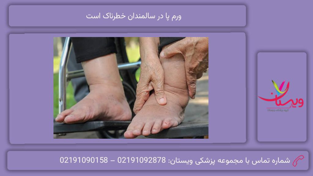 میزان خطرناک بودم ورم پا در بزرگسالان و مسنها ورم پا در سالمندان خطرناک است