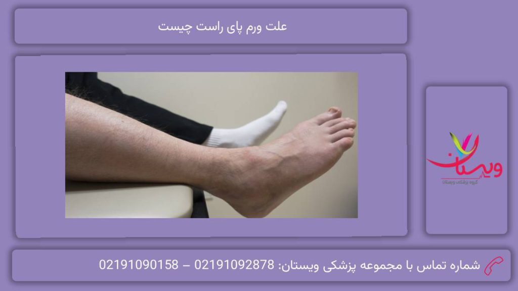 علائم همراه با ورم علت ورم پاها چیست