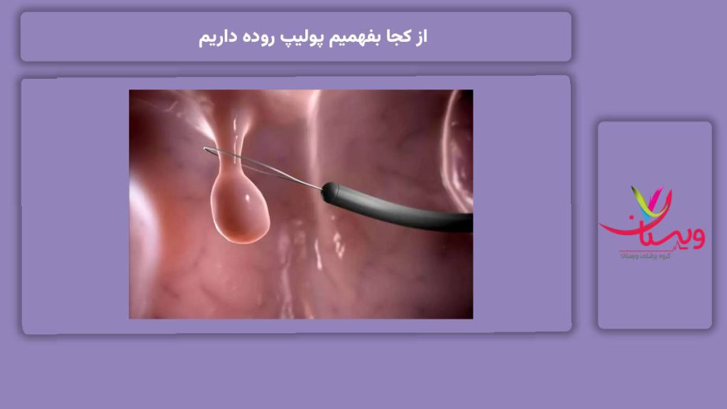 علائم اولیه بدن برای تشخیص پولیپ از کجا بفهمیم پولیپ روده داریم