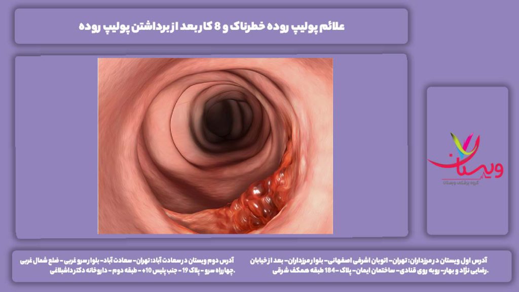 علائم پولیپ روده خطرناک