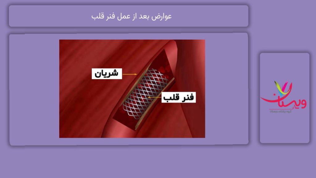 عوارض کوتاهمدت عوارض بعد از عمل فنر قلب