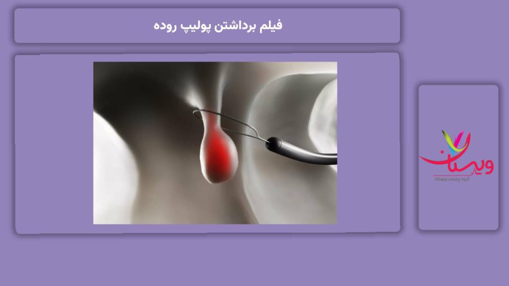 گامهای گرفتن فیلم برای پولیپ فیلم برداشتن پولیپ روده